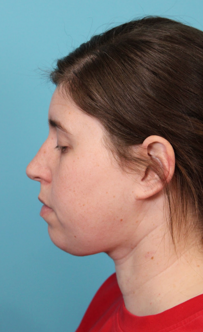 Submental Liposuction Before & After Patient #5074
