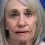 Laser Resurfacing Before & After Patient #5091