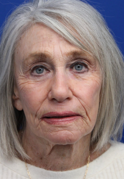 Laser Resurfacing Before & After Patient #5091
