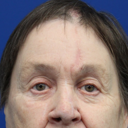 Mohs Surgery Before & After Patient #5069