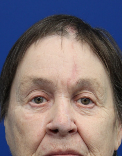 Mohs Surgery Before & After Patient #5069