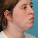 Submental Liposuction Before & After Patient #5074