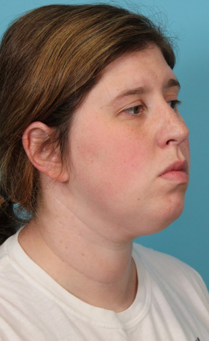 Submental Liposuction Before & After Patient #5074