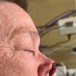 Mohs Surgery Before & After Patient #5069