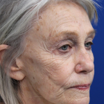 Laser Resurfacing Before & After Patient #5091