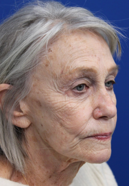 Laser Resurfacing Before & After Patient #5091