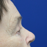 Mohs Surgery Before & After Patient #5069