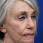 Laser Resurfacing Before & After Patient #5091