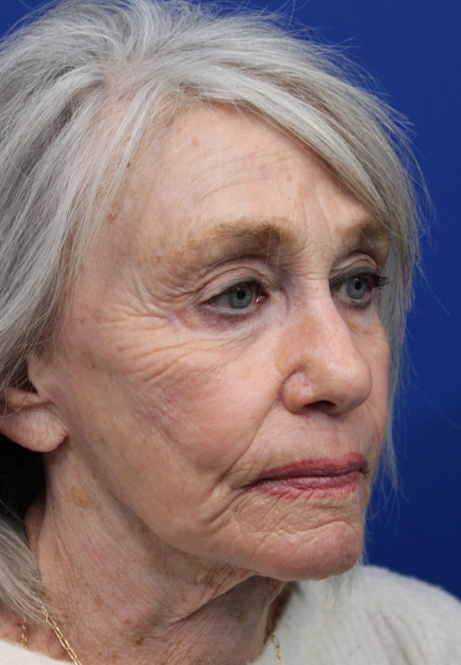 Laser Resurfacing Before & After Patient #5091