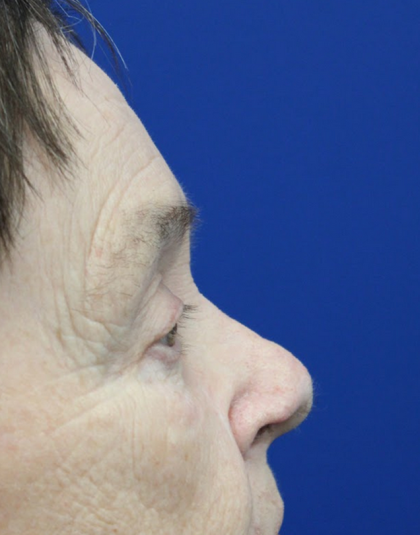 Mohs Surgery Before & After Patient #5069