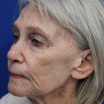 Laser Resurfacing Before & After Patient #5091