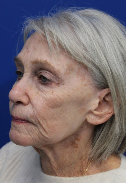 Laser Resurfacing Before & After Patient #5091