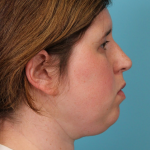 Submental Liposuction Before & After Patient #5074
