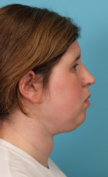 Submental Liposuction Before & After Patient #5074