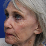 Laser Resurfacing Before & After Patient #5091