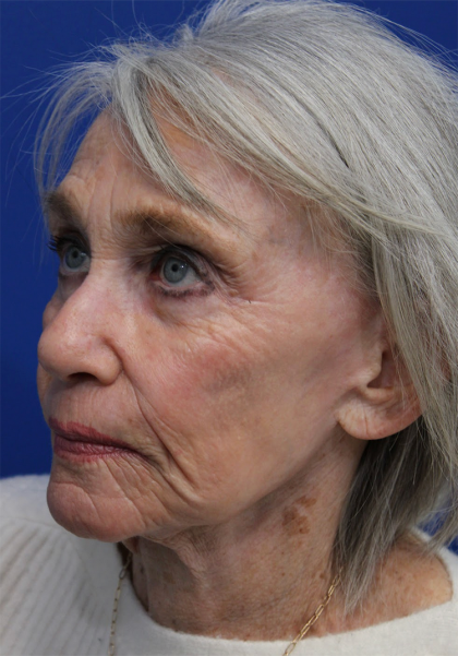 Laser Resurfacing Before & After Patient #5091