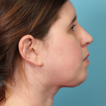 Submental Liposuction Before & After Patient #5074