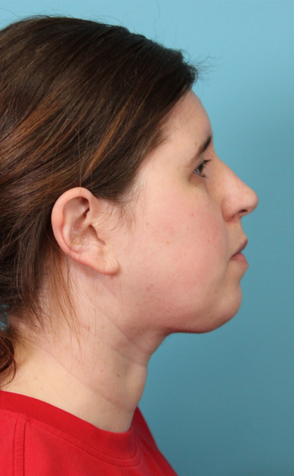 Submental Liposuction Before & After Patient #5074