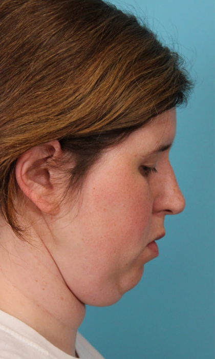 Submental Liposuction Before & After Patient #5074