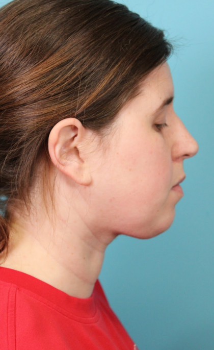Submental Liposuction Before & After Patient #5074
