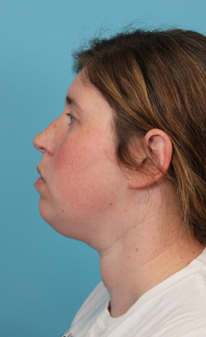 Submental Liposuction Before & After Patient #5074