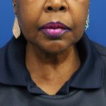 Facelift Before & After Patient #5149