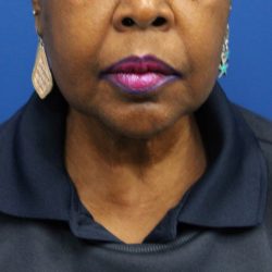 Facelift Before & After Patient #5149
