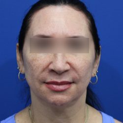 Facelift Before & After Patient #5150