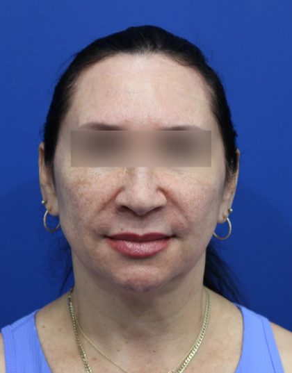 Facelift Before & After Patient #5150