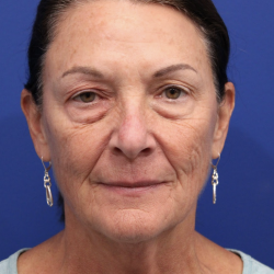 Upper Blepharoplasty Before & After Patient #5193