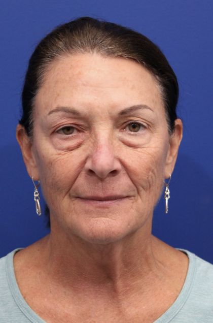 Upper Blepharoplasty Before & After Patient #5193