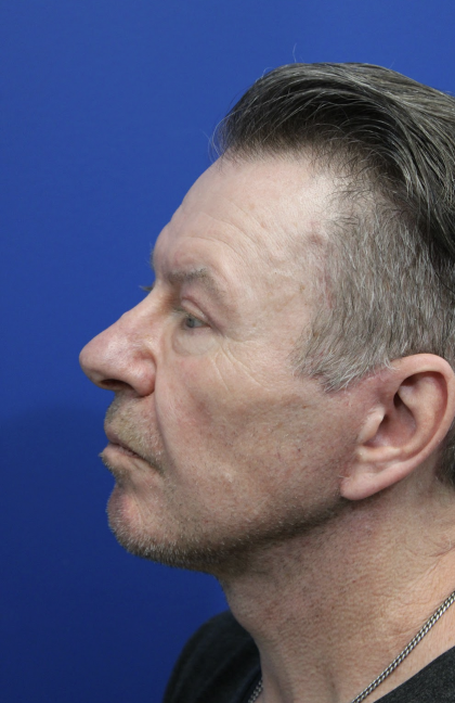 Facelift Before & After Patient #5146