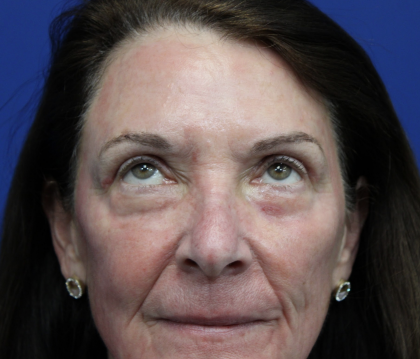 Laser Resurfacing Before & After Patient #5195