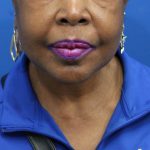 Facelift Before & After Patient #5149