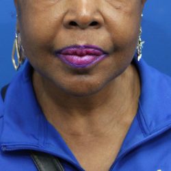 Facelift Before & After Patient #5149