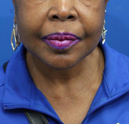 Facelift Before & After Patient #5149