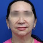Facelift Before & After Patient #5150