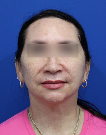 Facelift Before & After Patient #5150