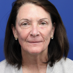 Upper Blepharoplasty Before & After Patient #5193