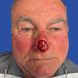 Mohs Surgery Before & After Patient #5220