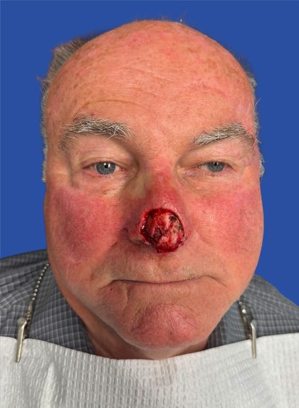 Mohs Surgery Before & After Patient #5220