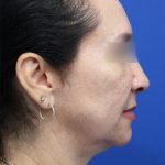 Facelift Before & After Patient #5150