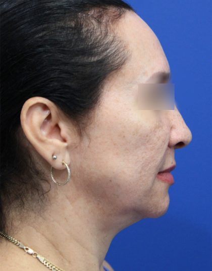 Facelift Before & After Patient #5150