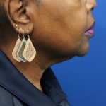 Facelift Before & After Patient #5149