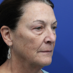 Upper Blepharoplasty Before & After Patient #5193