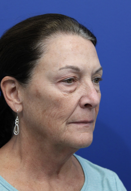 Upper Blepharoplasty Before & After Patient #5193