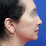 Facelift Before & After Patient #5150
