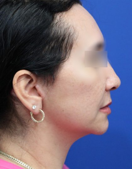 Facelift Before & After Patient #5150