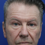 Upper Blepharoplasty Before & After Patient #5147