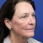 Upper Blepharoplasty Before & After Patient #5193